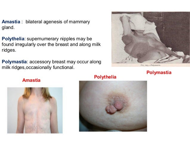 polymastia and breast Big com dick man